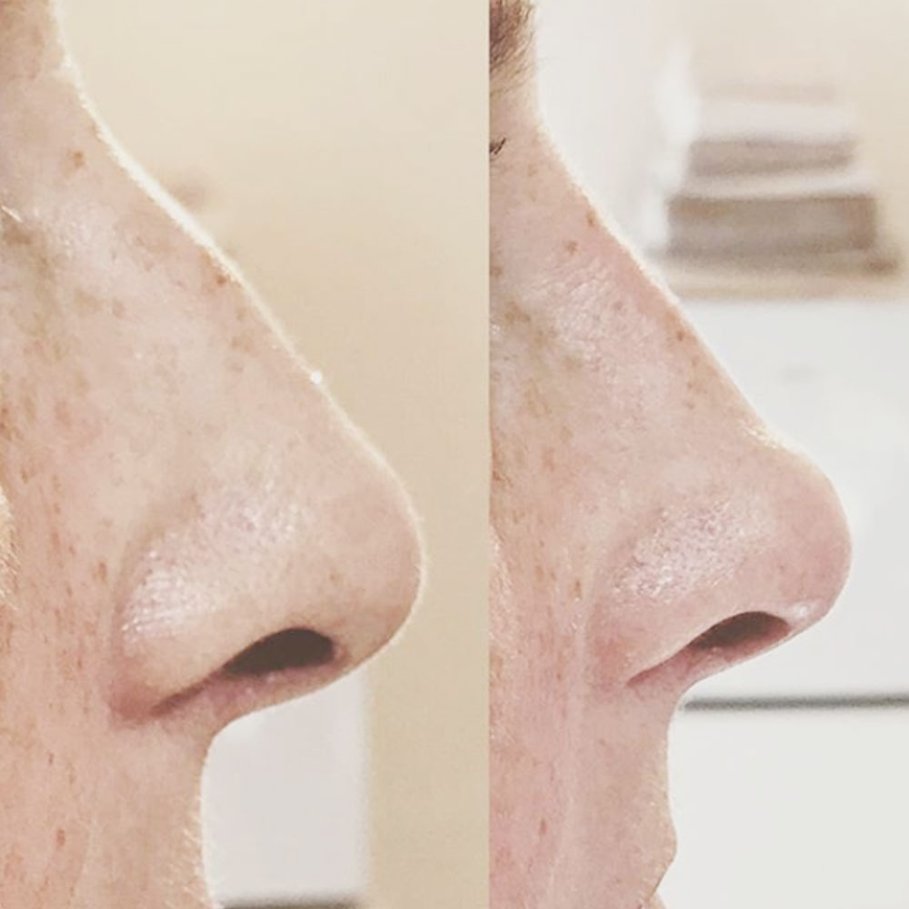 Non Surgical Rhinoplasty Hereford