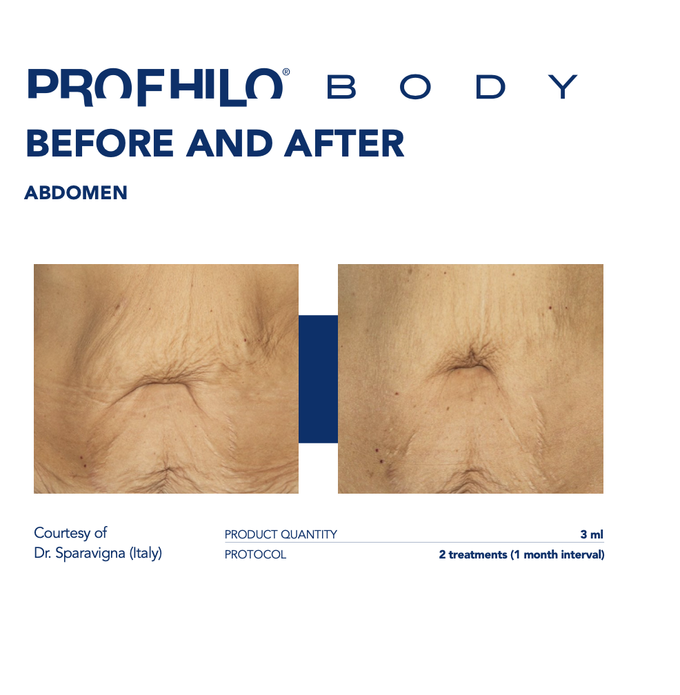 Profhilo body before and after